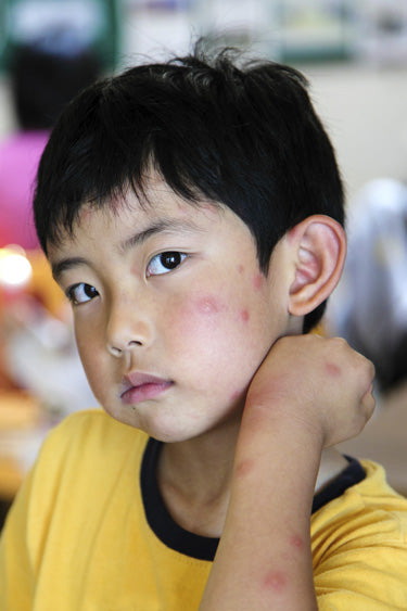 Blog - How to prevent and treat bug bites