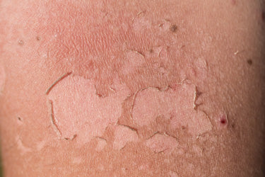 Blog - Sunburn Prevention and treatment