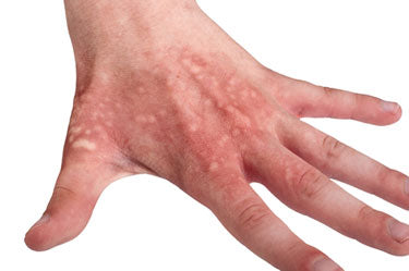 Blog - A basic guide to burns